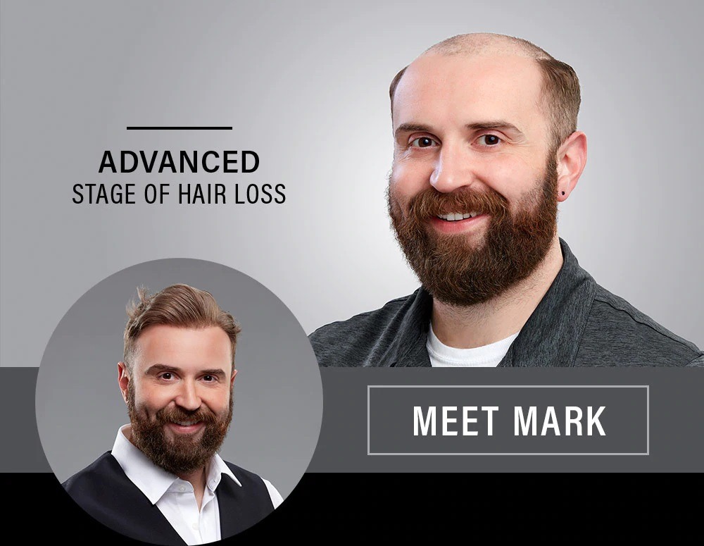 Mark has an advanced stage of hair loss