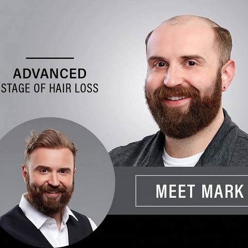 Cheveux Homme – Male Hair Replacement In South Africa