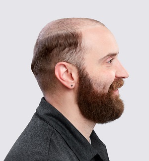 Man with alopecia showing the side of his head
