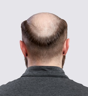 Man with thinning hair showing the back of his head